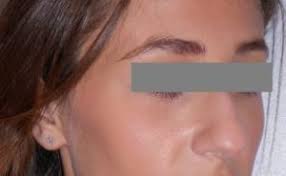 Rhinoplasty Before And After Pictures In Washington Vienna Va