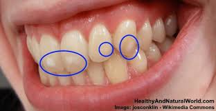 What foods strengthen your teeth? White Spots On Teeth Causes And Natural Treatments That Really Work