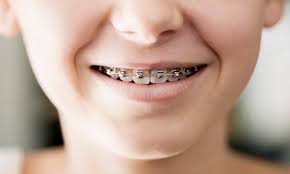 To help lessen her anxiety, girardi, then 45 years old, made a deal: Braces Could Be Harming Your Child S Teeth And Gums Claims Expert Daily Mail Online