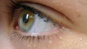 Si Te Eleminoni Pikat E Bardha Rreth Syve Me Limon Dhe Vaj Ulliri Cheek Acne How To Stop Pimples White Bump On Eyelid