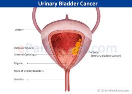 Sometimes, people with bladder cancer do not have any of these changes. Urinary Bladder Cancer Types Symptoms Stages Treatment Tur Surgery Immunotherapy