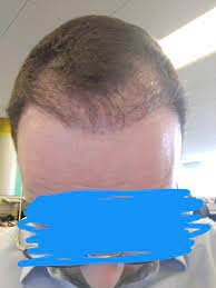 Hair Transplant 6 Months Result Is This A Failed Hair Transplant I Have Not Seen Much Growth In The Last 3 Months Hairtransplants