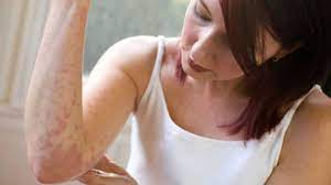 Pe de altă parte, persoanelor cu un sistem imunitar zona zoster în timpul sarcinii. Zona Zoster Poze Cauze Tratament Viata Sanatoasa