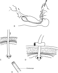 The technique of temporary witzel enterostomy and its indications are reported and results in 81 patients (99 enterostomies) retrospectively reviewed. Percutaneous Tube Management Musculoskeletal Key