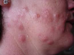 Bed Bug Bites That Look Like Mosquito Bites Are Bedbug Bites Dangerous Bed Bug Bites Bed Bugs Rid Of Bed Bugs