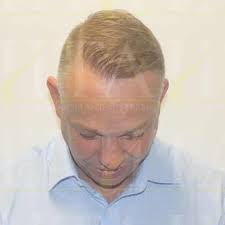 Hair Transplant Australia