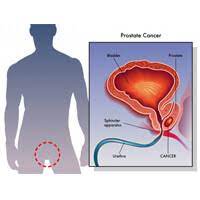 However, as with other types of cancer,. Prostate Screening Health Navigator Nz