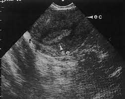 The uterine endometrial cavity may show contents of variable echogenicity if obstructed (e.g., from cervical stenosis in an older woman status . Diagnostic Ultrasonography In Gynecology Glowm