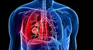 The stomach muscles contract periodically, churning food to enhance digestion. Surprising Lung Cancer Symptoms