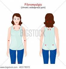 Trigger points are frequently mistaken for fibromyalgia tender points, even among healthcare thus, fibromyalgia patients can have both tender points and trigger points, possible at the same. Fibromyalgia Tender Vector Photo Free Trial Bigstock