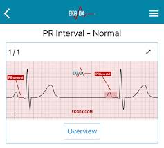 Image result for PR Interval