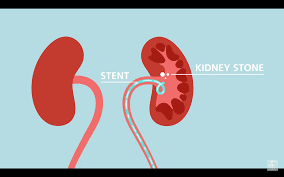 Some local anaesthetic gel is used and a small camera is inserted into the bladder via your urethra (water pipe) by one of the urology staff. Kidney Stones And Ureteral Stents Credible Patient Resources
