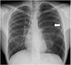 Pleural effusion (imaging) introduction 1. State Of The Art Radiological Investigation Of Pleural Disease Respiratory Medicine