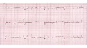 Image result for Post-MI Pericarditis