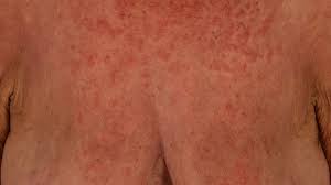 Entry into host cells is thought to occur by attachment of virions to cellular receptors and subsequent endocytosis. Exanthem Altmeyers Enzyklopadie Fachbereich Dermatologie