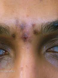 Image result for Postinflammatory Hyperpigmentation