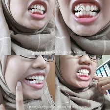 Jika tom cruise boleh memakai braces gigi pada usia 40 tahun, anda tidak seharusnya risau atau segan untuk memasangnya juga. Mek Onie Jongang Mek Onie