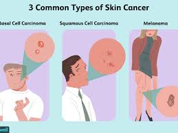 What you should know about melanoma. How Skin Cancer Is Treated