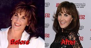 Phil has been indicated to have some cosmetic surgery . Robin Mcgraw Plastic Surgery Before And After Photos