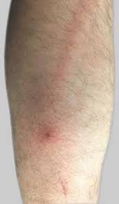 Image result for Nodular Lymphangitis