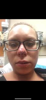 Traumatic Dog Bite Experience and Ongoing Fear