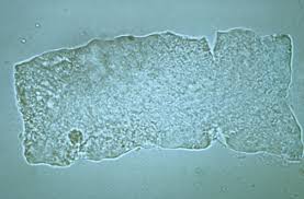 Image result for Urinary Cast