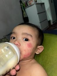 Ada tips tak nak tapper down steroid cream macam mana?