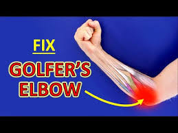 Golfer's elbow refers to pain that is typically on the inside of the elbow and originates in what is known as the common flexor tendon origin, where multiple muscles in the forearm attach to the elbow.the most common muscles involved with golfer's elbow are the pronator teres and the flexor carpi radialis, but it can also involve other wrist flexors including the flexor digitorum. How To Fix Golfer S Elbow Barcelona Chiropractor Blog