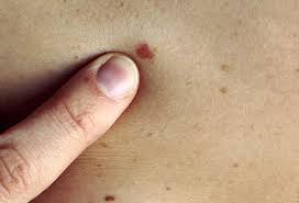 What is the treatment and prognosis for skin cancer? Skin Cancer Treatment Screening Medical Dermatologists In Ct