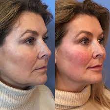 Treated Areas Cheeks Lips Nasolabial Folds Marionette Lines And Chin Juvederm Ultra Ultra Plus Vollure And Volum Nasolabial Folds Med Spa Voluma