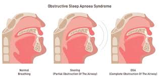 Image result for Obstructive Sleep Apnea