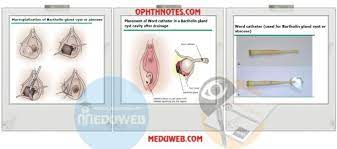 Management Of Bartholin Cyst And Abscess Meduweb Bartholin Cyst Treatment Cysts Cancer Doctor