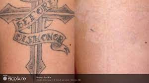 $49 for tattoo removal at luxe beauty now ($250 value). Picosure Laser Tattoo Removal Mansfield Arlington Dallas Ft Worth