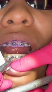 Here is why I choose to work with Gylcine Powder: , Glycine Powder: The  Scientific Advantage, Glycine air polishing powder is redefining  periodontal care — and the science backs it., Minimally ...