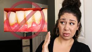 We brush our teeth in the morning to get rid of the plaque so that when we eat food there is no. Adult Braces Get Rid Of Tartar Plaque For 2 Youtube