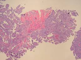 The accuracy of the pathological diagnosis is very important to the patients because they can be receive official compensation or relief when the diagnosis of. Pathology Outlines Mesothelioma