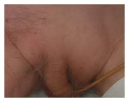 Local colon cancer symptoms affect your bathroom habits and the colon itself. Sigmoid Carcinoma In An Inguinal Hernia A Blessing In Disguise