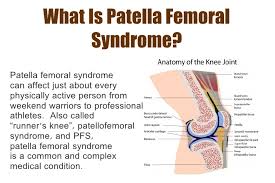 Patella Femoral Syndrome A Guide For Runners