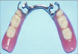 Check spelling or type a new query. Finished Distally Extended Removable Partial Denture Download Scientific Diagram