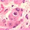 Peptic strictures cause a gradually progressive dysphagia for solid foods. Https Encrypted Tbn0 Gstatic Com Images Q Tbn And9gctreyjweib1ys0jxuwzs7uozwa0u091yb0q0vjif0tieow2zszj Usqp Cau