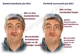 Uzman Fizyoterapist Zekeriya Kalkan Yuz Felci Kac Gunde Gecer Yuz Felci Cesitli Etkenler Yuzunden Ortaya Cikabilir Vucut Direncindeki Azalma Bile Yuz Felci Sebebi Olabilir Yuzde Her Yarida Beyin Sapindan Cikan Ve