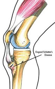 Osgood Schlatters Disease And Osgood Schlatters Treatment