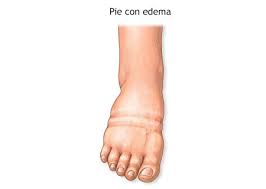 Image result for Tropical Edema