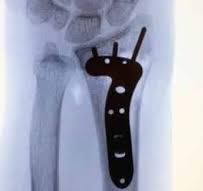 Volar Locking Plate Fixation of Distal Radius Fractures: A ...