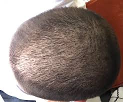 Hence, it is not uncommon to witness a baby's infact, in a lot of asian cultures, it is mandatory to shave the head of the baby after a particular age in order to promote hair growth (mostly within the. I Shaved My Head About 11 Days Ago And My Hair Grows Uneven Mildlyinteresting