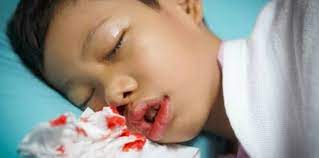 Ada dua tipe pendarahan pada hidung: Hidung Berdarah Saya Nak Minta Pendapat Or Siapa2 Yang Perna