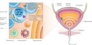 Intravesical Device Assisted Therapies For Non Muscle Invasive Bladder Cancer Nature Reviews Urology