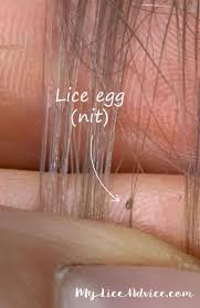 Many people try to deter lice with hair products such as hair spray and hair gel. Dealing With Head Lice Can Be Difficult For Anyone But It Can Be Especially Difficult For Those With Blonde Hair In 2020 Lice Eggs Hair Lice Lice Prevention Shampoo
