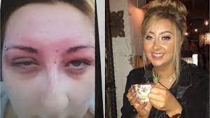 There are two types of henna tattoos, one is brown henna, which is safe for most people to use on their skin, and the dye can also be used for coloring hair, nails and various materials. Woman Who Developed Life Threatening Allergy To Black Henna Warns Others Of Risks Itv News Wales