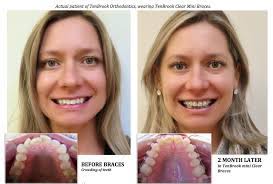 Discover the most modern transparent aligner system worldwide and transform your smile. What S The Fastest Way To Straighten Your Teeth